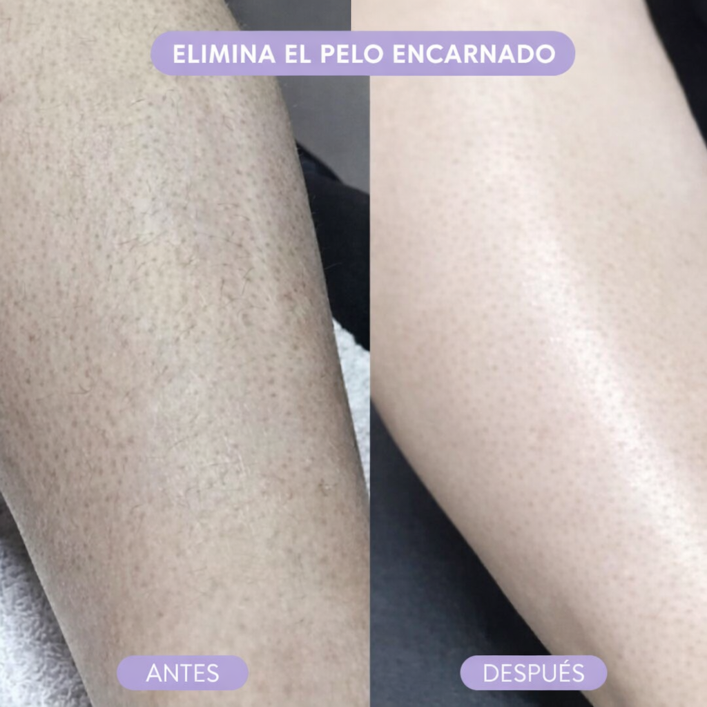 Depiladora Glem Crystal